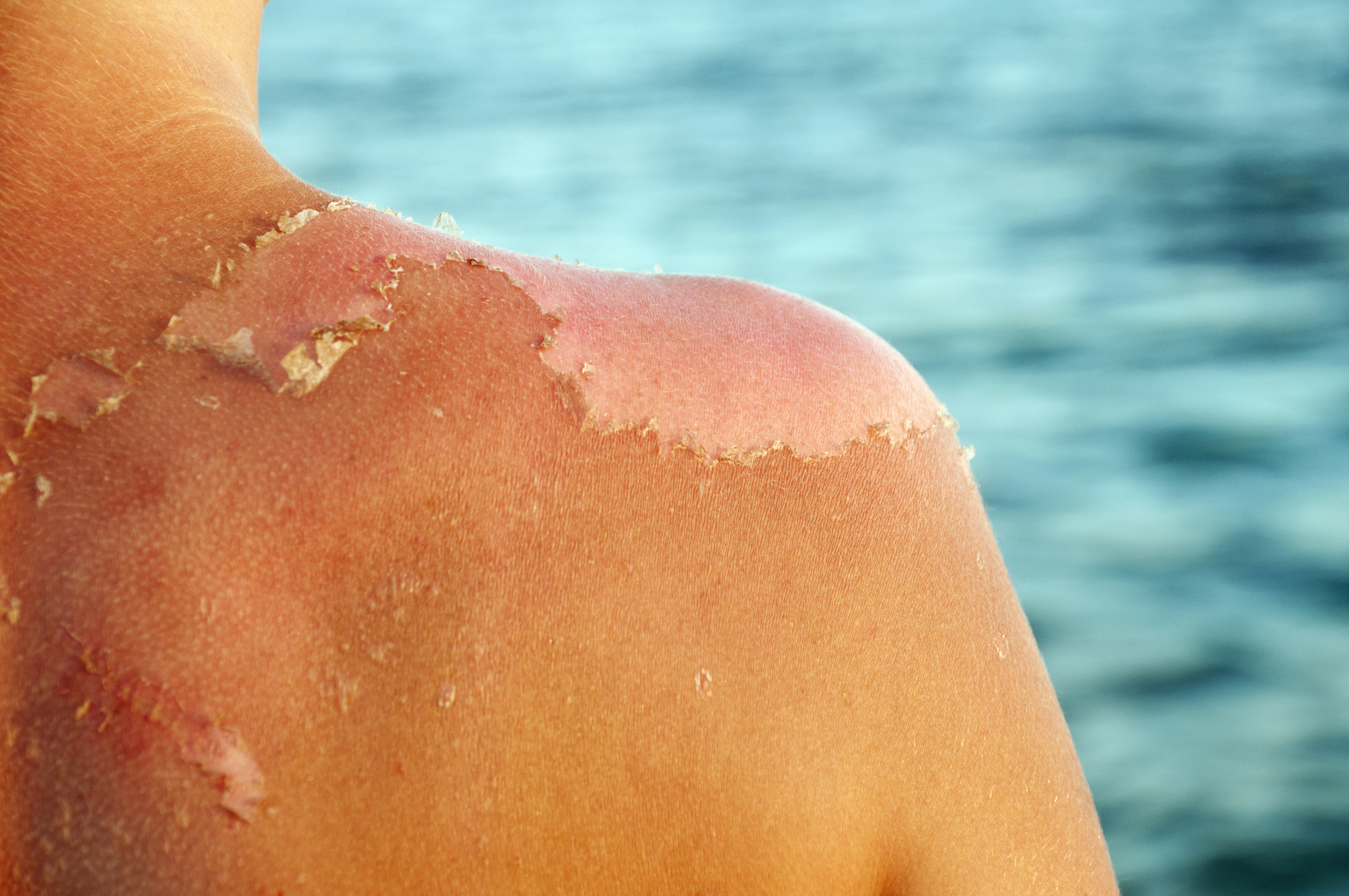 A day in the sun can be fun, as long as you remember to wear sunscreen.